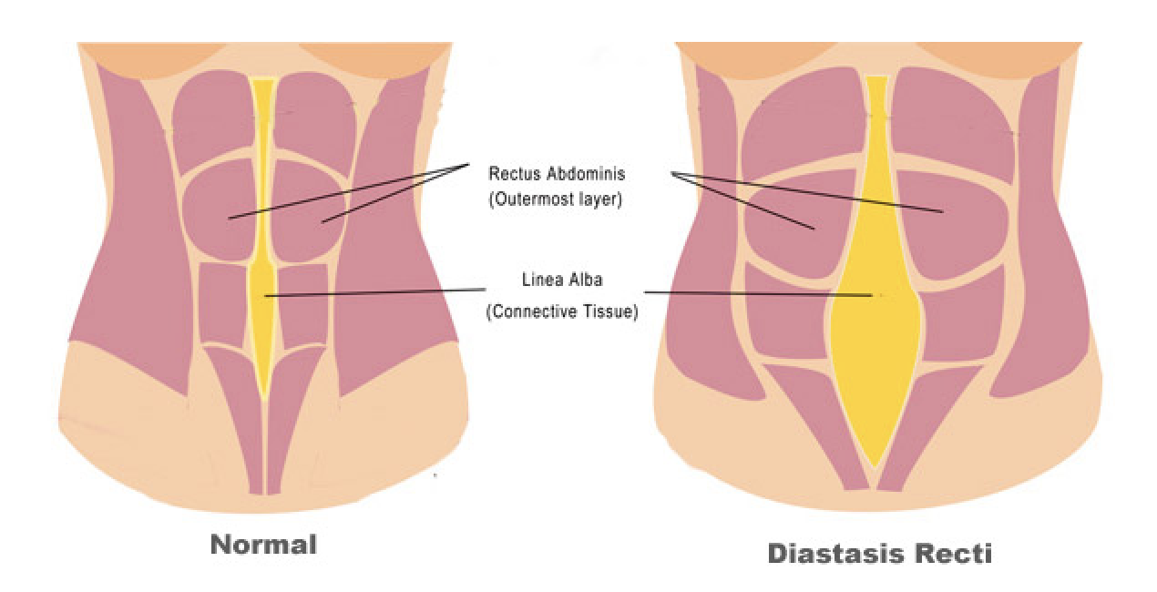 Mummy Tummy  How To Do A Diastasis Recti Assessment & How Big Is My Gap  After Baby #3 